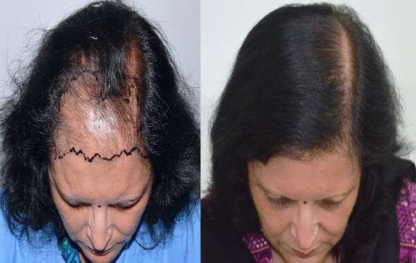 Sự thật về phương pháp cấy tóc được ví như 'đũa thần' chữa hói đầu
